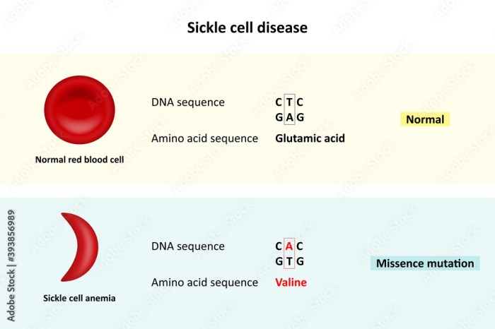 Sickle cell anemia nclex questions