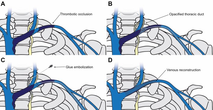 Thoracic venous cannulation duct