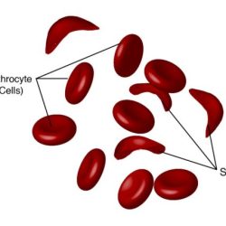 Sickle cell anemia nclex questions