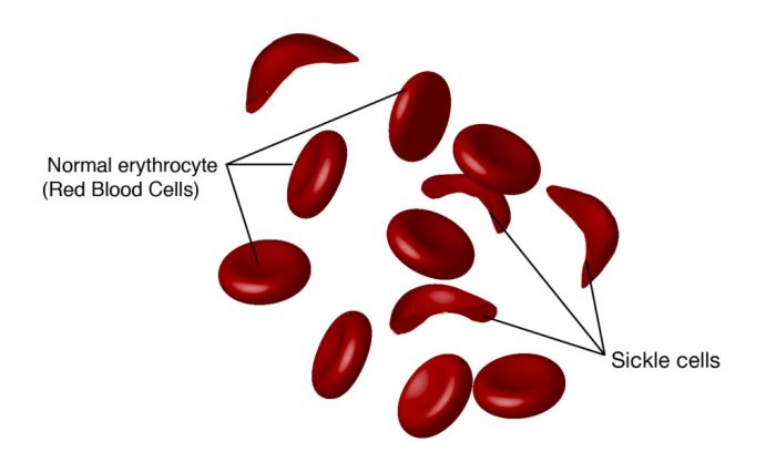 Sickle cell anemia nclex questions